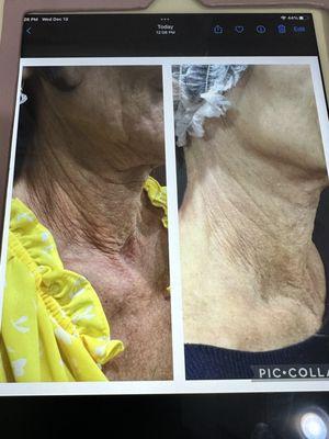 Before and after pics after a treatments of radiesse