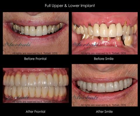 Full Mouth Implant Reconstruction