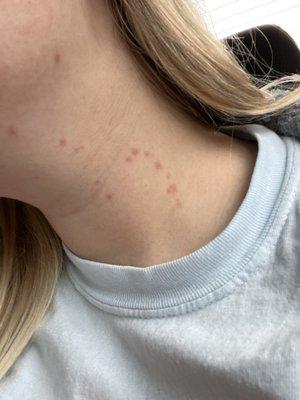 Bug bites