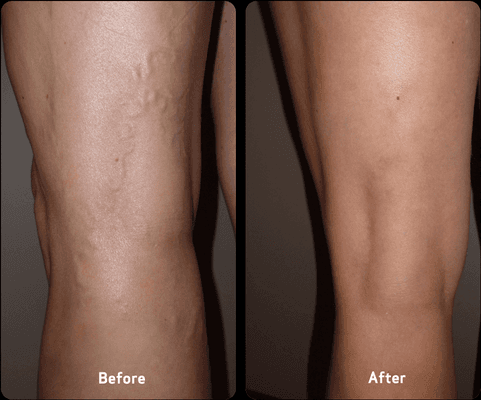 USA Vein Clinics Before and After Treatment