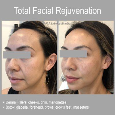 Total facial rejuvenation: neuromodulators and dermal fillers were used on the entire face