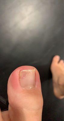 my toe with infection.