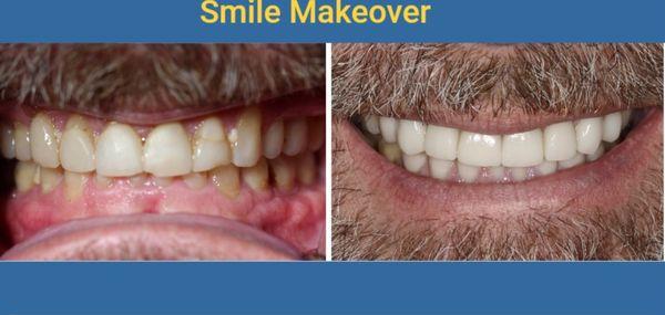 Smile Makeover