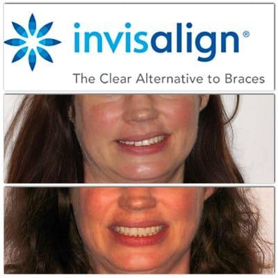 Our finished Invisalign case, patient Laura is thrilled with the results and so are we!