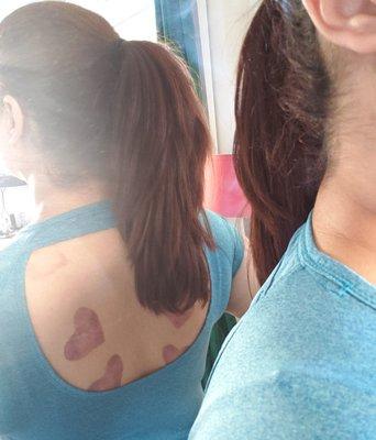 Heart shaped cupping