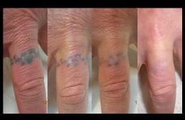 Finger Laser Tattoo Removal