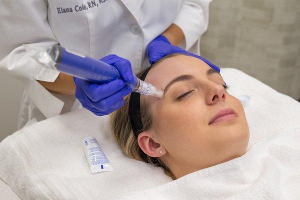 Microneedling procedure at Advanced Dermatology, Glencoe.