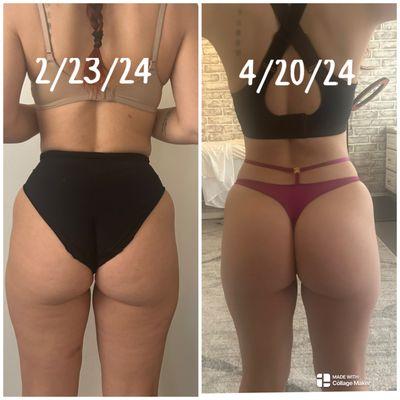 Results from Endermologie and cavitation .