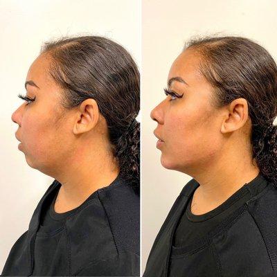 Chin filler by Olivia