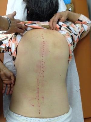 Scoliosis BEFORE: curved spine and pain