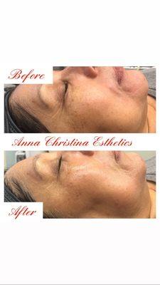 This beautiful lady had the lift and tighten facial. This Korean skin treatment leaves your face lifted, lightened and so smooth.