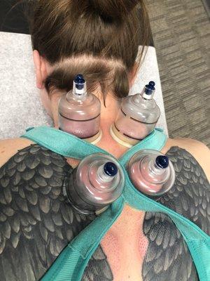 Cupping