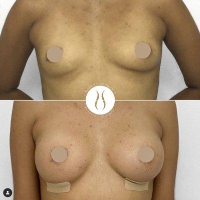 Breast augmentation- 2 months post op.