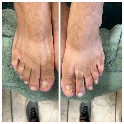 End result, client had no more discomfort. 
Recommended getting foot care about every three months.