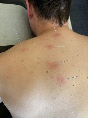 Dry Needling is cutting-edge therapy designed to treat chronic muscle and joint pains!