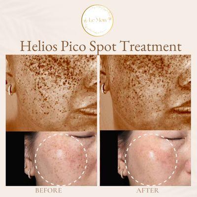 Helios Pico Spot Treatment