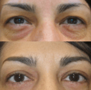 Before and After! 45-Year-Old Female
 Upper & Lower Eyelid Procedures