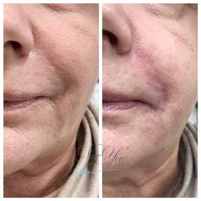 Restylane/Juvederm for smile lines. (Picture taken right after treatment, redness & swelling will fade).