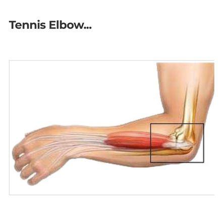 Over 1500 cases of tennis elbow healed! What are you waiting for???