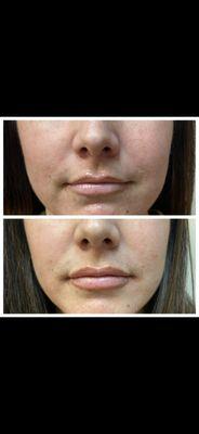 Lip filler results can be minimal or drastic