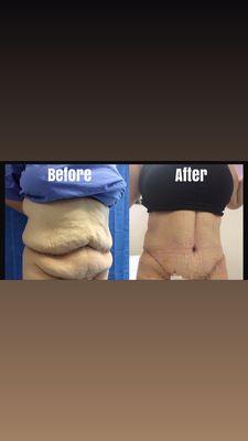 Tummy tuck