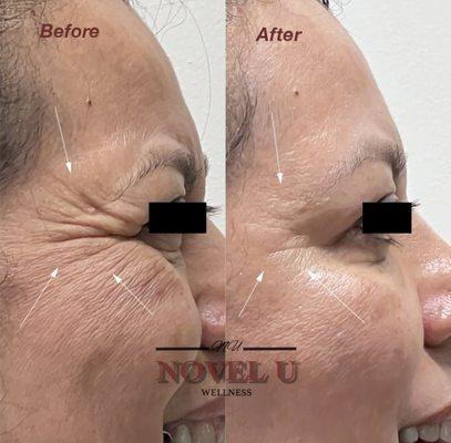 Crow's feet line correction with Botox