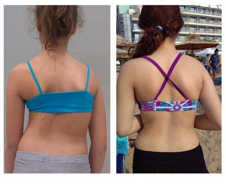 One year of therapy corrected her posture immensely!