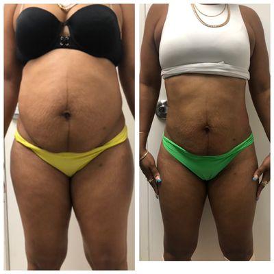 Cool Body Contour- 3 months from the start! Congrats!