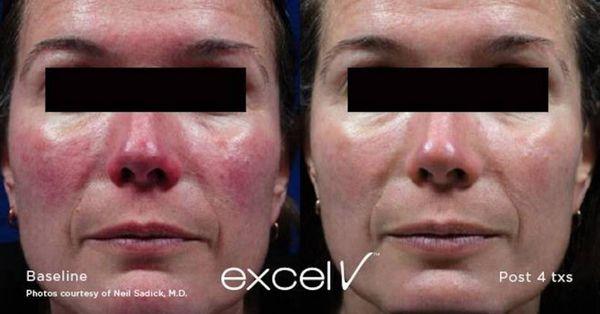 We treat rosacea & spider veins.