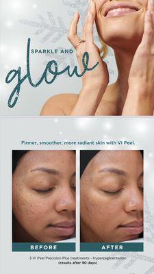 Vi Peel for all skin types