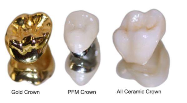 SPECIAL FOR CERAMIC CROWNS!!!
$300 off (limited time)