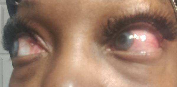 Day 2 , my eye was still having reactions to their eyelash glue (redness, painful, burning sensation)