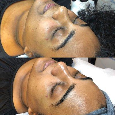 Instant results after an intense hydrating & anti-aging facial