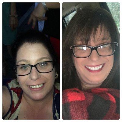 Left before Right after! Amazing and I love to smile all the time now!