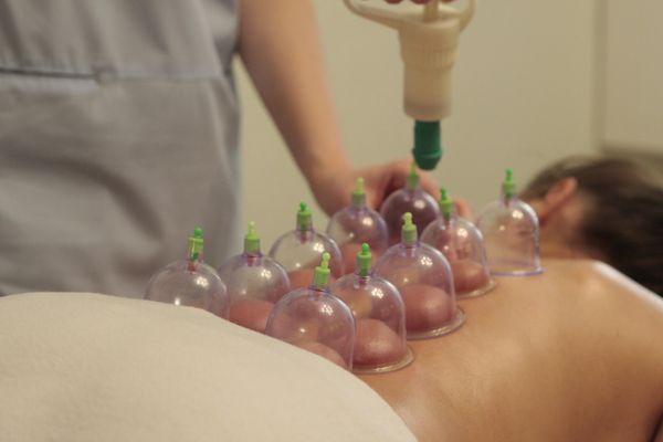 cupping therapy