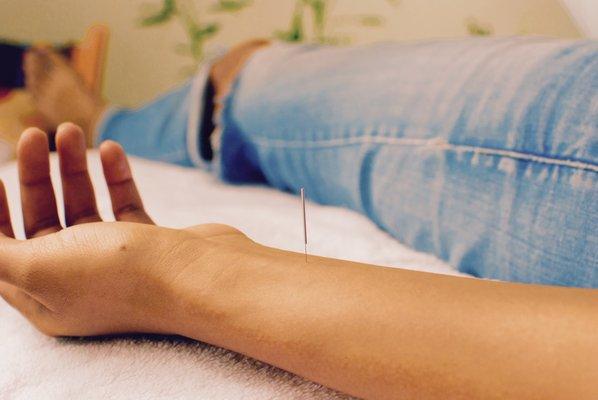 A patient relaxes while enjoying acupuncture point Pericardium 6, an important point for alleviating  motion sickness and anxiety.