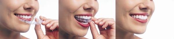 Invisalign Clear Aligners