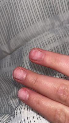 Damage done to nails after removal