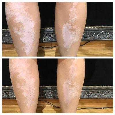 Vitiligo improved with the Fractional CO2 laser at Innate Beauty