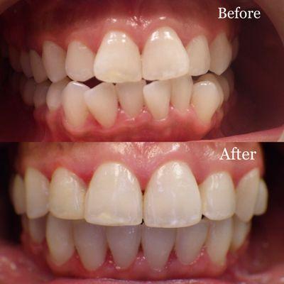 Another successful story of our patient's before and after braces treatment.