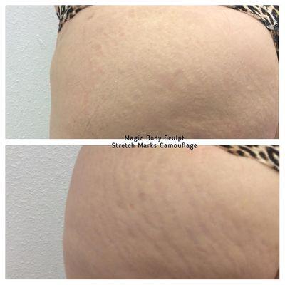 Before and After Camouflage, New Brazilian Technique to Treat Stretch Marks, Scars and Dark Circles www.magicbodysculpt2u.com