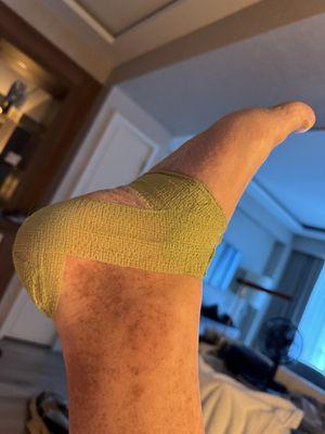 Wrapped foot to keep bandage in place to prevent infection