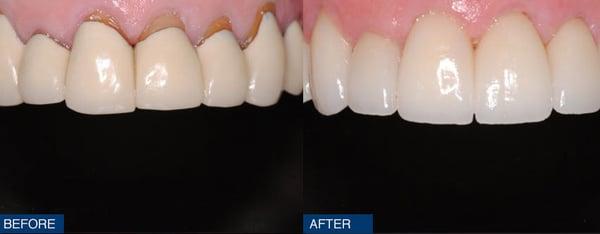 This lady didn't like her old crowns and the "black line" near her gums.  All porcelain crowns gave her a gorgeous smile.