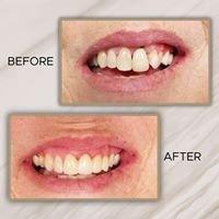 Dental Crowns, Port Arthur Smiles Port Arthur Texas