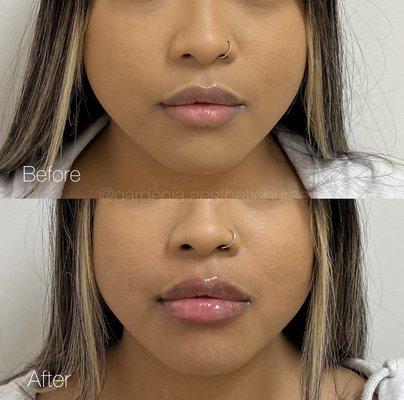 Lip filler by nurse gardenia