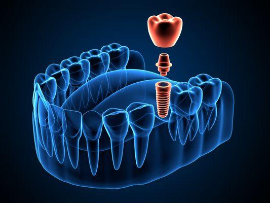 NOVA Periodontics & Dental Implants