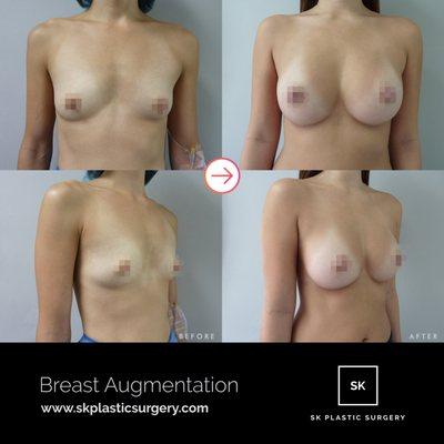 This patient underwent bilateral breast augmentation via periareolar incision with 286cc moderate plus profile silicone implants.