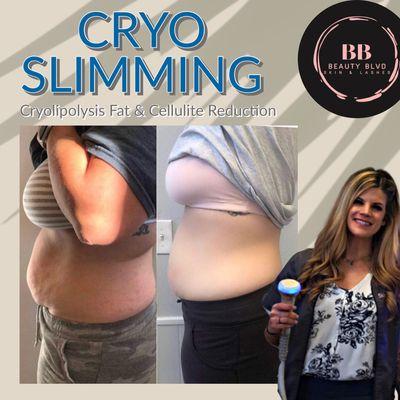 Cryolipolysis