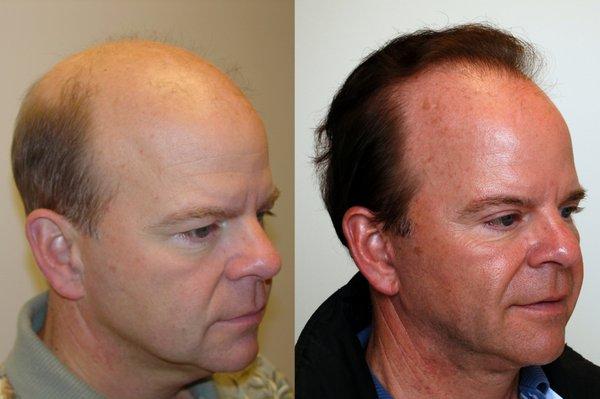 Before and After Hair Restoration Procedure