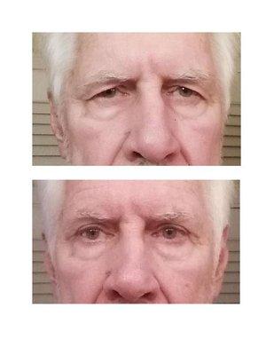 Before and After Blepharoplasty